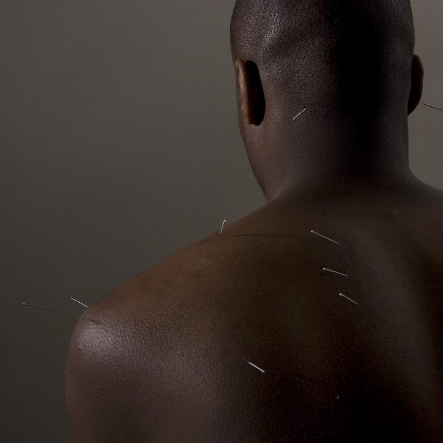 Rich results of Googles SERP showing acupuncture for back and shoulder pain